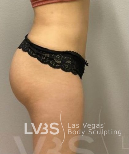 Brazilian Butt Lift (Fat Transfer to Butt) Before & After Patient #837