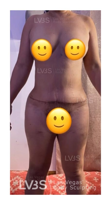 Liposuction Before & After Patient #812