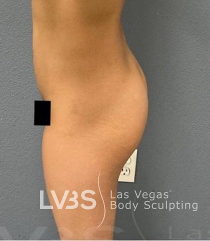 Brazilian Butt Lift (Fat Transfer to Butt) Before & After Patient #837