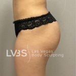 Brazilian Butt Lift (Fat Transfer to Butt) Before & After Patient #837