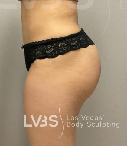 Brazilian Butt Lift (Fat Transfer to Butt) Before & After Patient #837