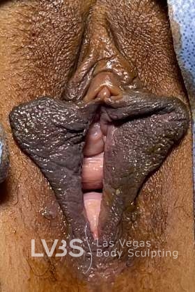 Labiaplasty Before & After Patient #829