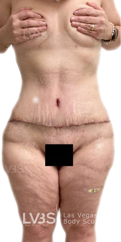 Liposuction Before & After Patient #826