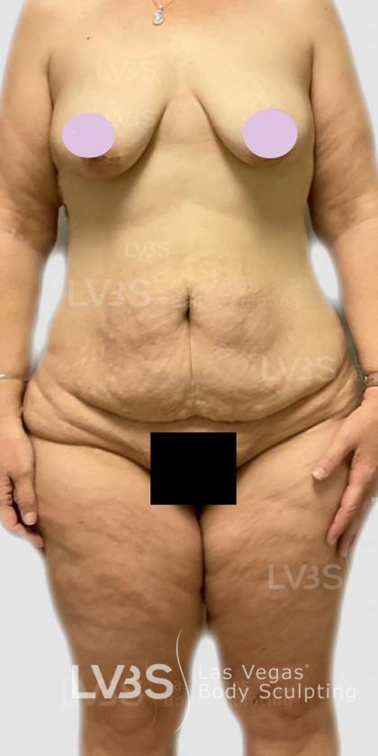 Liposuction Before & After Patient #826