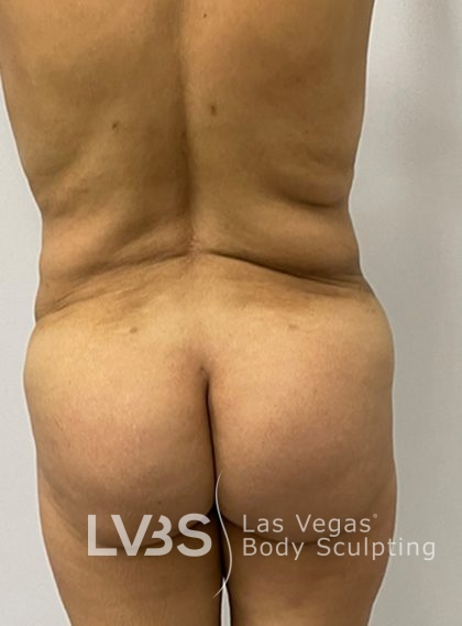 Brazilian Butt Lift (Fat Transfer to Butt) Before & After Patient #844