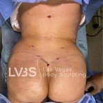 Brazilian Butt Lift (Fat Transfer to Butt) Before & After Patient #844