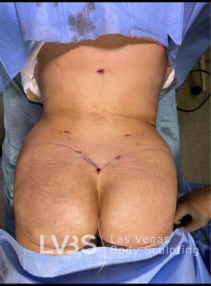 Brazilian Butt Lift (Fat Transfer to Butt) Before & After Patient #844