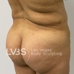 Brazilian Butt Lift (Fat Transfer to Butt) Before & After Patient #844