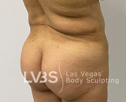 Brazilian Butt Lift (Fat Transfer to Butt) Before & After Patient #844
