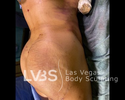 Brazilian Butt Lift (Fat Transfer to Butt) Before & After Patient #844