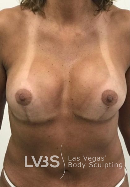 Breast Lift Before & After Patient #1072