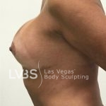 Breast Lift Before & After Patient #1072
