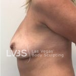 Breast Lift Before & After Patient #1072