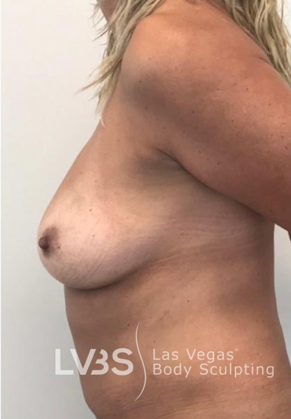 Breast Lift Before & After Patient #1072