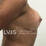 Breast Lift Before & After Patient #1072