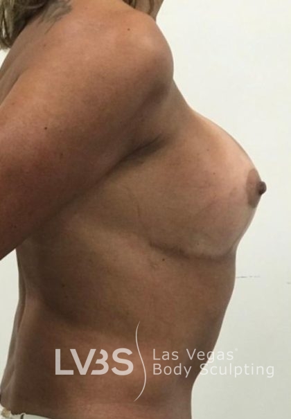Breast Lift Before & After Patient #1072