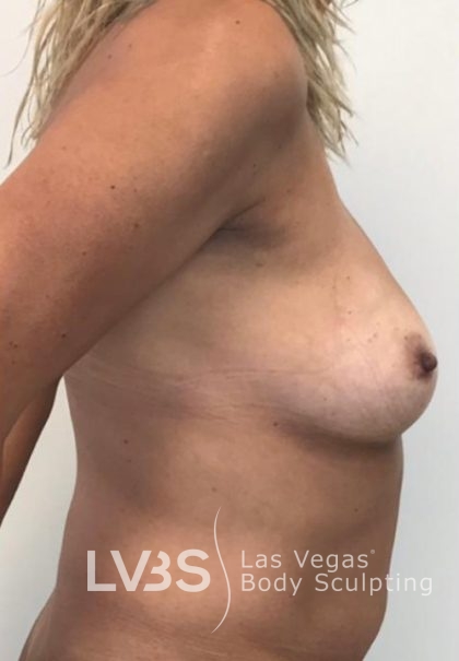 Breast Lift Before & After Patient #1072