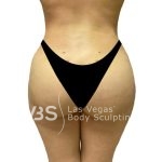Brazilian Butt Lift (Fat Transfer to Butt) Before & After Patient #1144