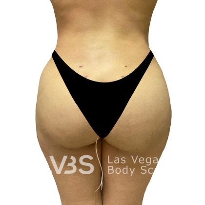 Brazilian Butt Lift (Fat Transfer to Butt) Before & After Patient #1144