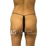 Brazilian Butt Lift (Fat Transfer to Butt) Before & After Patient #1149