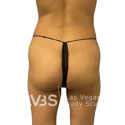 Brazilian Butt Lift (Fat Transfer to Butt) Before & After Patient #1149