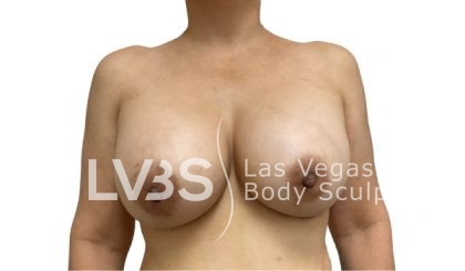 Breast Implants Exchange Before & After Patient #1101