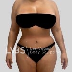 Tummy Tuck Before & After Patient #1132