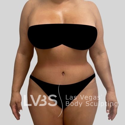 Tummy Tuck Before & After Patient #1132
