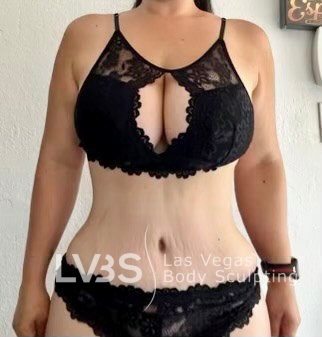 Tummy Tuck Before & After Patient #1129