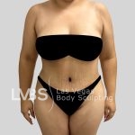 Tummy Tuck Before & After Patient #1130