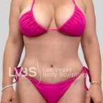 Tummy Tuck Before & After Patient #1133
