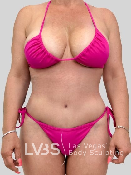 Tummy Tuck Before & After Patient #1133