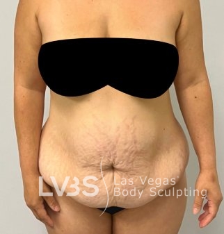 Tummy Tuck Before & After Patient #1129