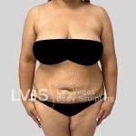 Tummy Tuck Before & After Patient #1130