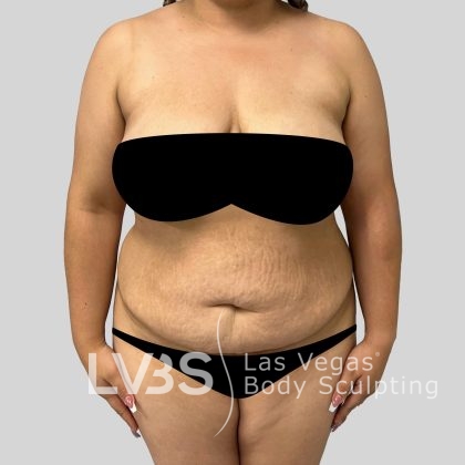 Tummy Tuck Before & After Patient #1130