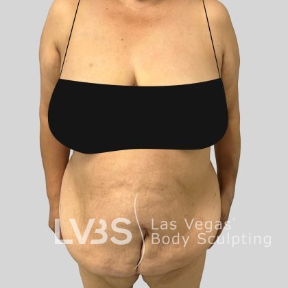 Tummy Tuck Before & After Patient #1131