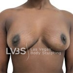 Breast Implant Before & After Patient #1095