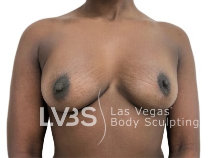 Breast Implant Before & After Patient #1095